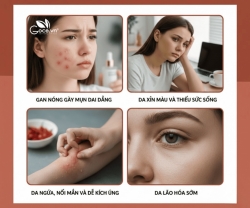 Gan Nóng Làm Làn Da Ngày Càng Mụn, Xỉn Màu Dù Chăm Sóc Đều Đặn?