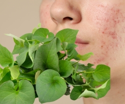 Rau Diếp Cá Trị Mụn Nội Tiết Có Hiệu Quả Không?
